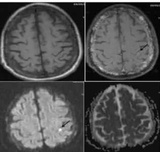 Figure  3.  a-d.  A  61-year-old  woman  with  lung  cancer.  Axial  T1-  weighted  (a),  fat-saturated  contrast  enhanced  T1-  weighted (b), diffusion-weighted MR images(c) and ADC map (d) show diffuse involvement of cranial bone marrow and  parenchyma 