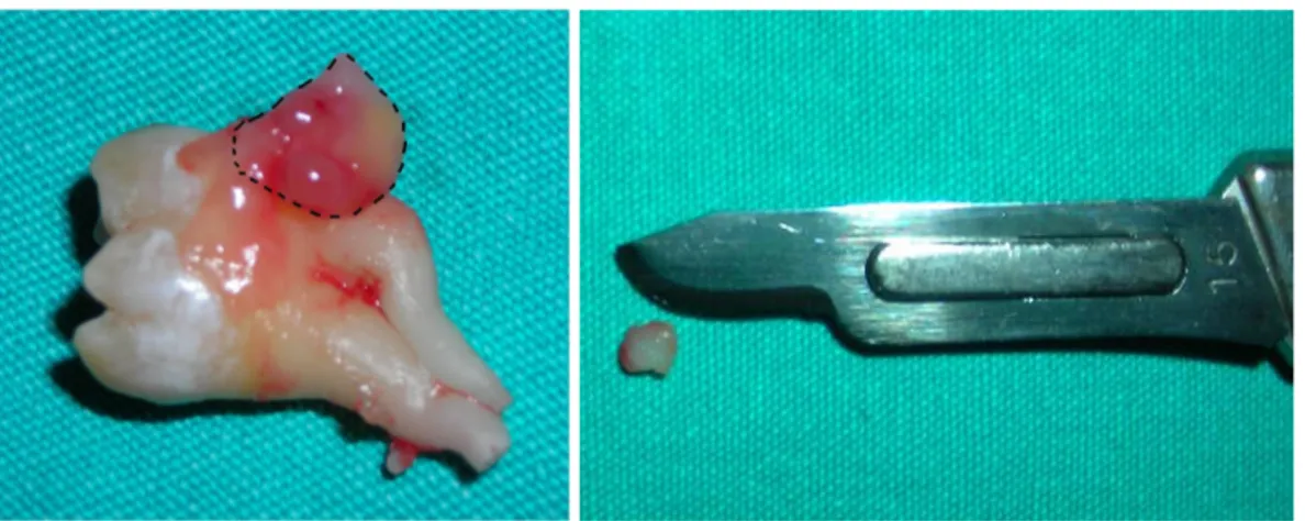 Şekil  3.1.  Gömülü  20  yaş  diş  etrafında  bir  kese  gibi  bulunan  dental  folikül  dokusunun  (kesikli  çizgiyle  belirtilmiş)  elde  edilmesi  ve  insizyon  esnasında  çıkarılan dişeti