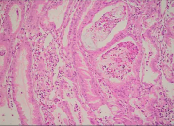 Figure 1.  Edema and congestion in the gastric mucosa, abundant  eosinophils in the tunica propria and on the surface