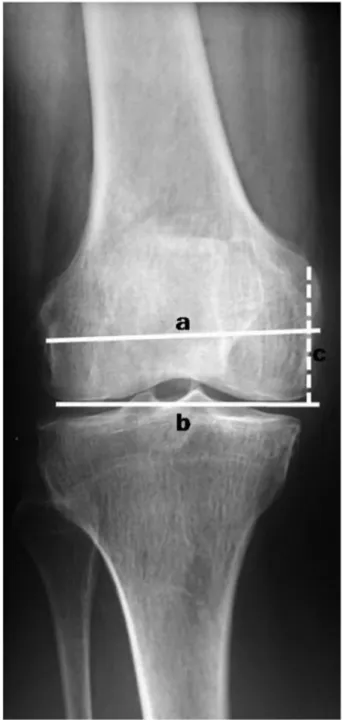 Fig. 1. Axes on anteroposterior plain radiograph of the knee. a: femoral width (FW), b: joint line (JL), c: adductor tubercle-joint line distance (ATJL).