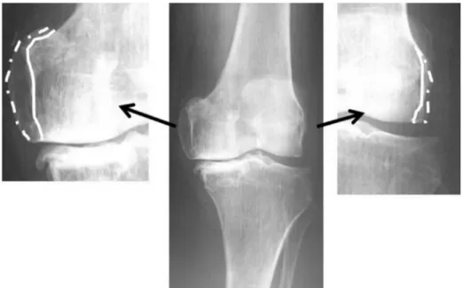 Fig. 2. Boundaries of the medial and lateral osteophytes (dash-dotted line) and the original femur (straight line).