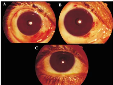Table 2 Pterygium types in two groups 