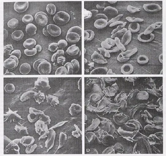 Şekil 2.2. Orak Hücre Hastalığında Eritrositlerin Elektron Mikroskobik Görünümü 