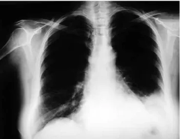 FIG. 1. Chest radiograph of Patient 1, showing an infiltrate in the left lower zone