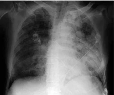 FIG. 3. Chest radiograph of Patient 2, showing patchy, bilateral pulmonary  infiltrates