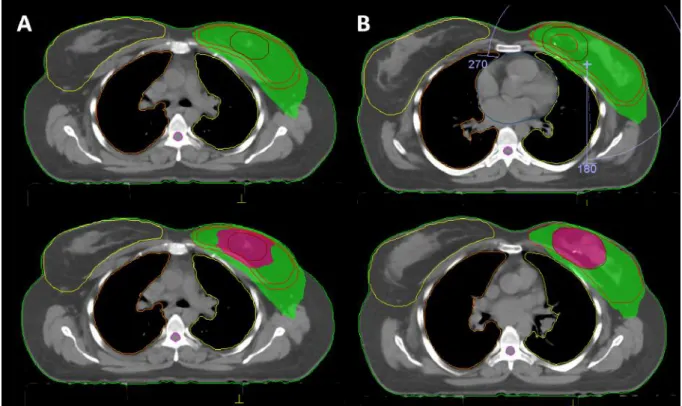 Figure 1. Dose distribution demonstrating 95% prescribed dose of whole-breast irradiation (green area) and tumor-bed boost (magenta area) of sequential boost (A) and simultaneous-integrated boost techniques generated with VMAT plan