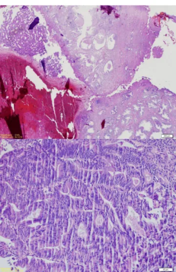 Figure 1-2. Adenoid and cribriform structures with atypical columnar epithelium  without stroma between the benign prostate glands (Hematoxilen&amp;Eosinx200).