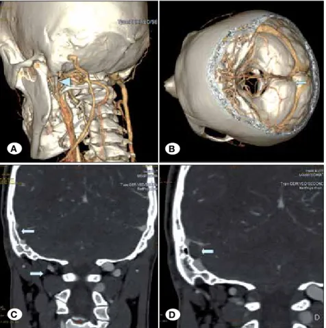Figure 1: 3D volume-rendering CT images  show bilateral long styloid process and right  transverse-sigmoid sinus thrombosis related  to the right jugular vein compression by the  styloid process (A,B)