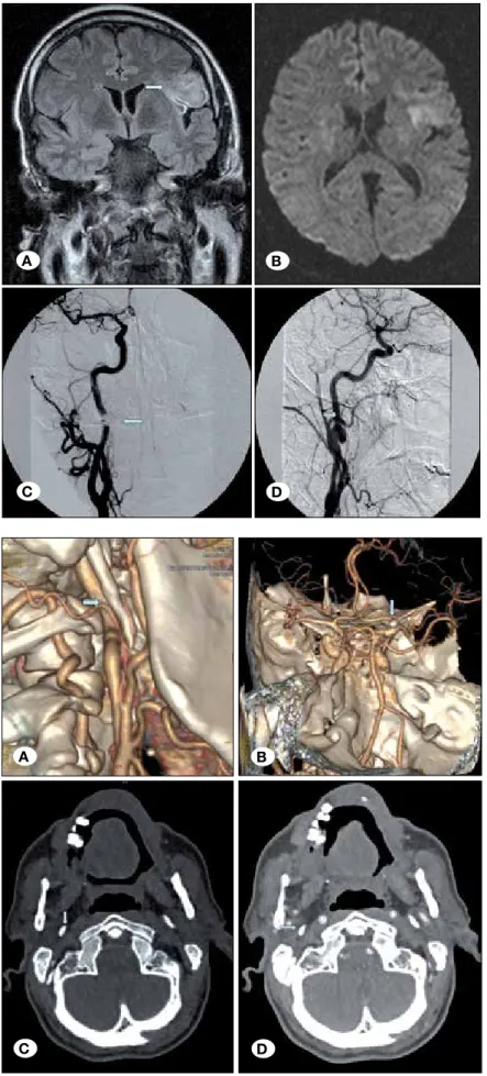 Figure 3: Coronal FLAIR MRI scan (A) and diffusion- diffusion-weighted MRI scan (B) reveals ischemia in parietal  region
