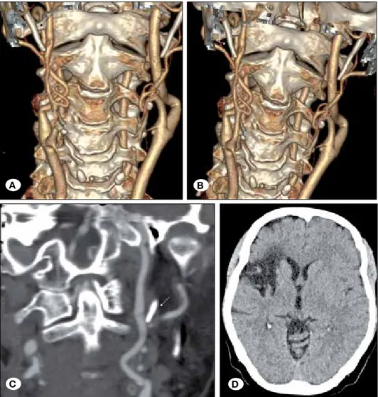 Figure 5: 3D volume-rendering  CT images (A,B) and coronal  CT-angiography image (C) show bilateral  long styloid process (arrows)
