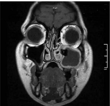 Figure 2. Magnetic resonance imaging showing ectopic tooth in  the left maxillary sinus and contrast enhancement due to soft tissue  inflammation (T1, contrast-enhanced coronal section) 