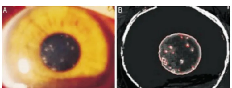 Figure 1 Images of a patients with subepithelial infilatrates A: Anterior segment photography of a patient showing subepithelial infiltrates around the pupil border taken by a digital camera; B: Analysis of the subepithelial infiltrates by a software in th
