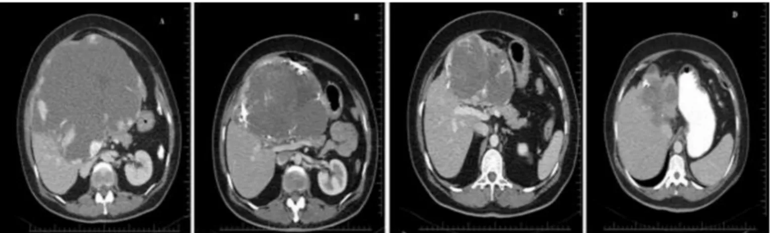Fig. 3. A; Comparison of giant hemangioma size at 1, 6, and 12 months after embolization with bleomycin with pre-procedural size, B; Comparison of the size of the second non- non-intervened hemangiomas at 1, 6, and 12 months with pre-procedural size.