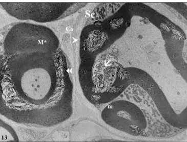 Figure 12: Sciatic nerve section from trauma group. M; myelinated  nerve fibers, ; separation of the lamellae, ; duplication, M*;  local disarrangement in myelin coat, A; normal structured axon,  +; unmyelinated fibers, Co; collagen fibers (Uranyl aceta