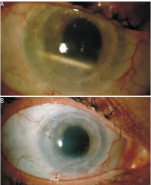 Figure 2 Anterior segment photography A: The appearance of the Ozurdex ® implant in the anterior chamber; B: Regressed pearl