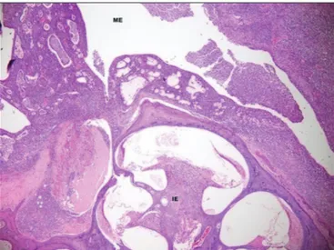 Figure 1. Group1 rats, acute suppurative inflammation in middle ear (ME);  there is no involvement in inner ear ( İE), routine histological characteristics  (suppuration +++, fibrosis-).