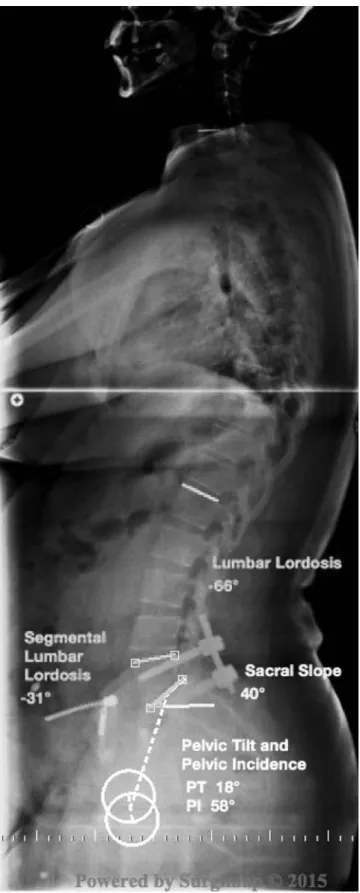 Fig. 3. The postoperative measurements of spinopelvic parameters were made and recorded in X-ray.