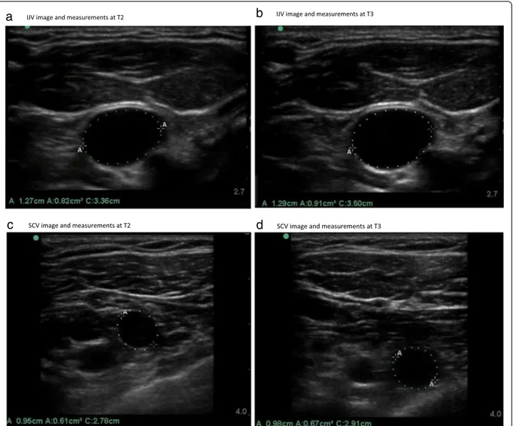 Fig. 1 Images from a patient ’s IJV and SCV measurements by time point T2 and T3. a IJV image and measurements at T2