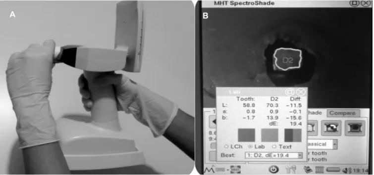 Figure 3. (A) Color assessement using a Spectroshade Micro device. (B) Measurement screen of the device.