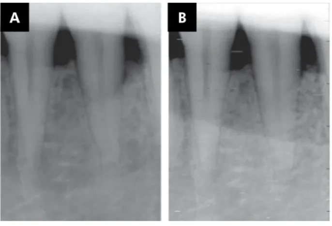 Figure 4. Control group: (A) periapical radiograph of the  intra-bony defect at baseline; (B) periapical radiograph of the  intra-bony defect at 6 months after ABBM treatment.