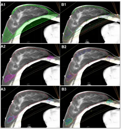 Figure 2. Dose distribution in the FIF plan. (A1)  Healthy tissue receiving 95% of the prescribed  dose (yellow area)