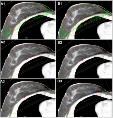 Figure 3. Dose distribution in the wedge plan. (A1)  Healthy tissue receiving 95% of the prescribed  dose (yellow area)