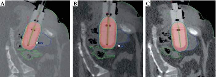 Fig. 1. The 4 Gy isodose area (red) according to the vaginal cylinder in the (A) neutral, (B) parallel, and (C) angled positions in 