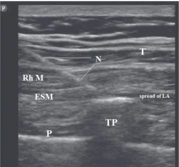 Figure 1. Scanning ultrasonogram displaying Trapezius (T), 