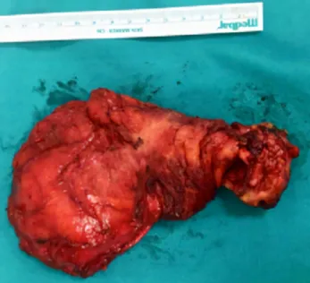 FIGURE 2. Postoperative macroscopic appearance of mass.FIGURE 1. Thorax computed tomography.