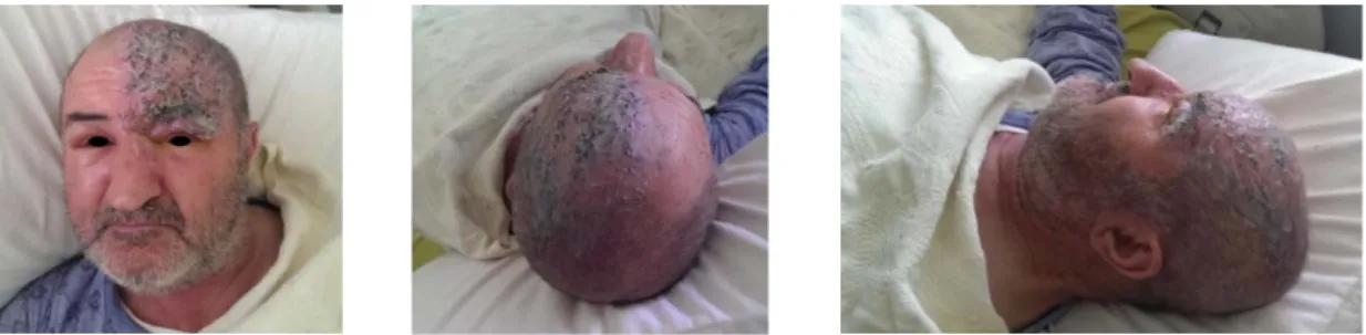 Figure 1. Diffuse periorbital edema of left eye, vesicular lesions and crusting on left periorbital area and  forehead 