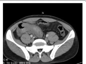 Figure 4 An unexpected ileocecal mass (red arrow). Final pathology of the specimen is malign mesenquimal tumor.