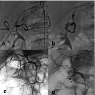 FIG. 1. a-d. Gastroduodenal pseudoaneurysm was detected by celiac angiography. 