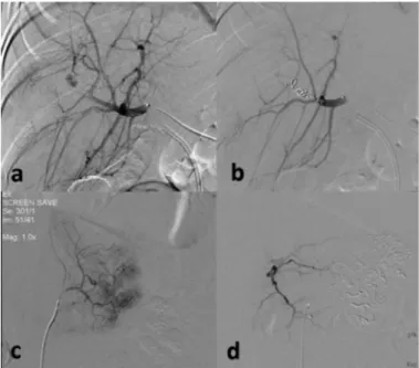 FIG. 2. a-d. Superselective hepatic angiography demonstrated hepatic artery aneurysm 