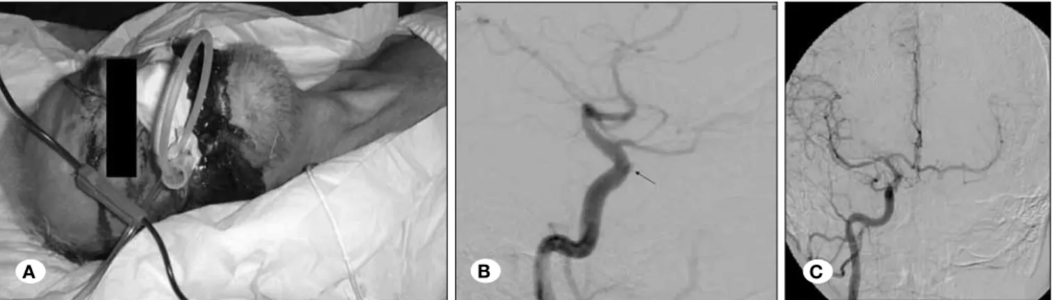 Figure 3: 52 y/o male patient with  post-operative active bleeding  after skull-base surgery (A)