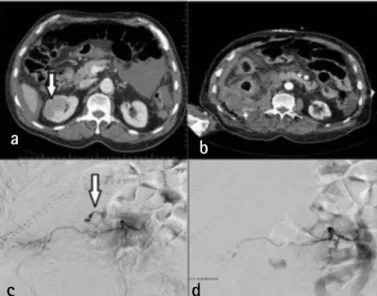 Figure 1. a) Preoperative abdominal computed tomography scan shows the  mass (arrow) located at the lateral side of the right kidney