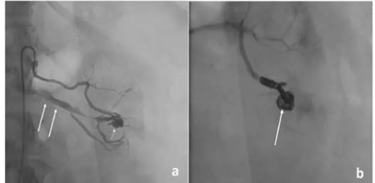 Figure 1. a) A 51-year-old woman’s left renal selective angiogram after 