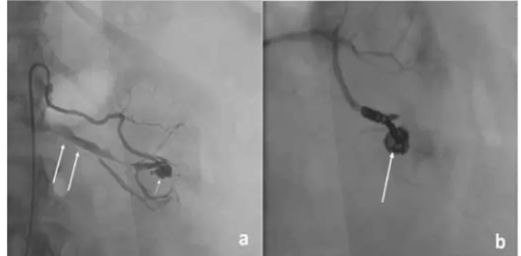 Figure 1. a) A 51-year-old woman’s left renal selective angiogram after 