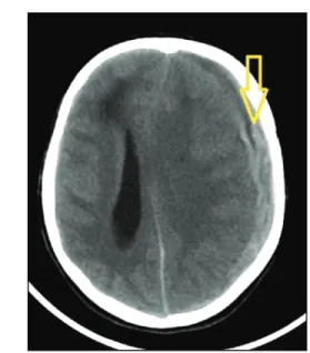 Figure  5: Diagnostic cerebral angiogram shows dissecting  wide-necked left MCA aneurysm and wide-necked complex basilar  type aneurysm after embolization