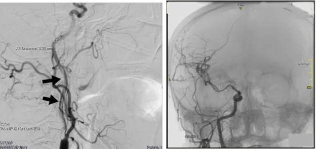Figure 1. Lateral selective right carotid DSA image shows     Figure 2. AP cerebral angiography shows; partial blood  
