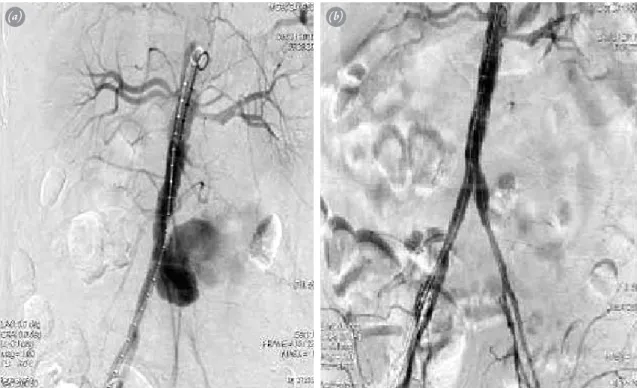 Fig. 1.  (a) Abdominal contrast-enhanced CT image shows left iliac artery rupture and pseudoaneurysm (arrow)