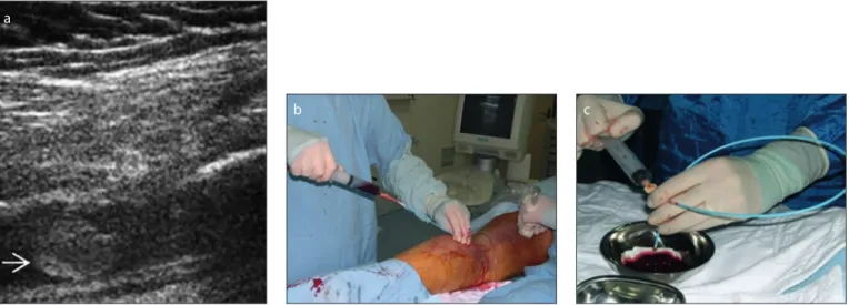 Figure 2. a–c. Aspiration thrombectomy procedure under real-time US guidance. a