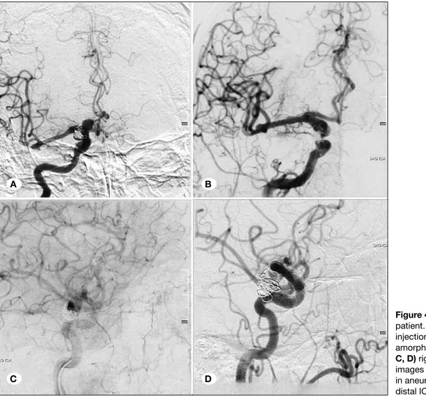 Figure 4: A 72-year-old male  patient. A, B) AP right ICA  injection shows recurrent  amorphous aneurysm,  C, D) right anterior oblique  images show stagnation of flow  in aneurysmal sac and patent  distal ICA branches