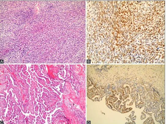 FIGURE 1. Enhancer of zeste homologue 2 (EZH2) expression in two histological types of synovial sarcoma (SS)