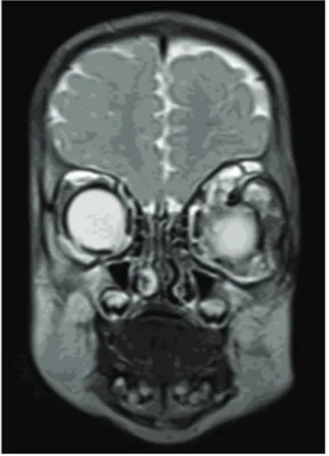 Figure 6: Orbital CT scan at one year of age showing the proptosis of the globe and some cystic spaces between the extraocular muscles in the left orbit.