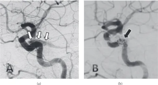 Figure 3: Early arterial phase of the lateral carotid angiography with the filling of the carotid sinus via the fistula ((a) white arrows) and lateral carotid angiogram with the fistula completely closed after transvenous coil embolization ((b) black arrow