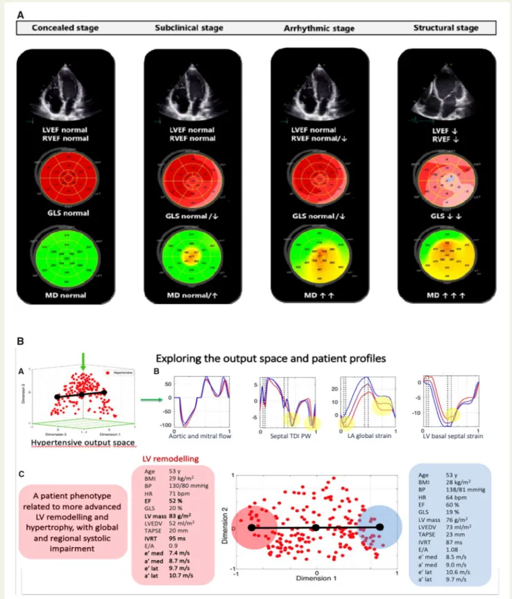 Figure 2 (A) Classification of PLN (Phospholamban) mutation (R14del) carriers on the basis of deformation characteristics