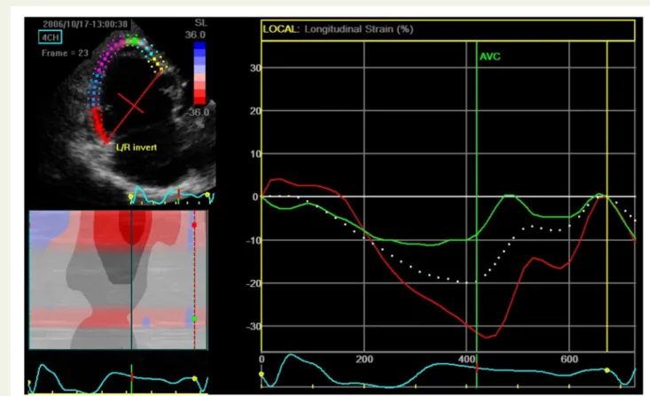 Figure 5 EMD in the functional right ventricle in a patient with Ebstein’s malformation, demonstrating difference in time to peak shortening be- be-tween the RV basal segment (red line) and apical septum (green line)