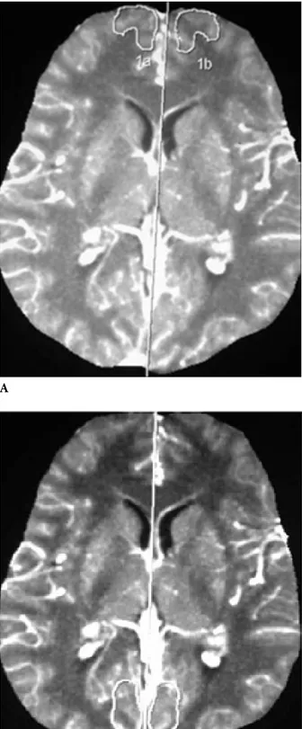 Figure 1. MIP perfusion of pCT at the basal ganglia. A-Frontal, B-Temporal, C-Occipital, D-Lentiform nucleus with freehand drawn  ROI.AC B D