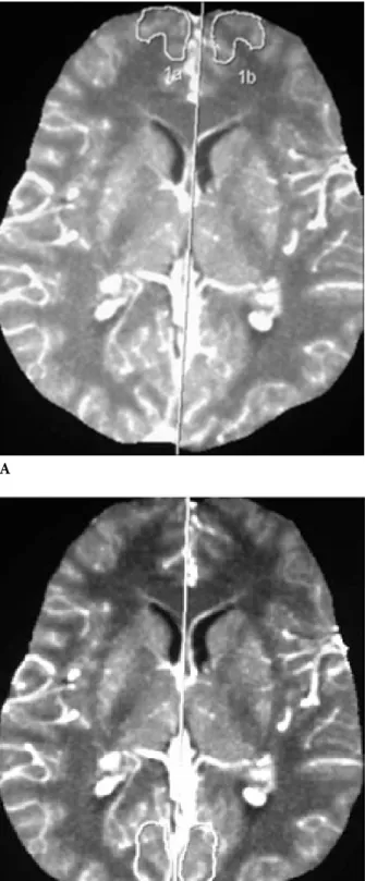 Figure 1. MIP perfusion of pCT at the basal ganglia. A-Frontal, B-Temporal, C-Occipital, D-Lentiform nucleus with freehand drawn  ROI.AC B D