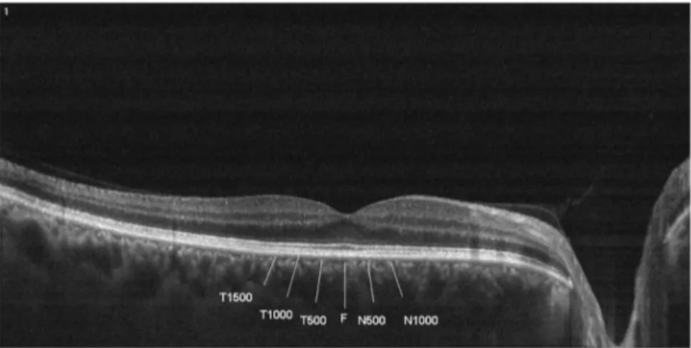 Table 1 Mean ± SD (in μm) of choroidal thickness measure- measure-ments of groups 1, 2, 3, and 4